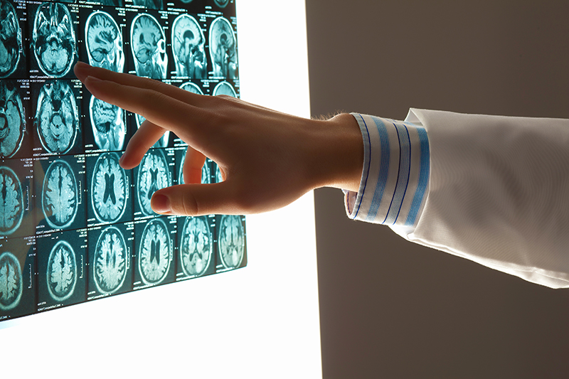 Doctor examines brain scans looking for signs of Alzheimers and dementia